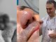 Burnunu it dişləyən xəstəyə yenisi formalaşdırıldı