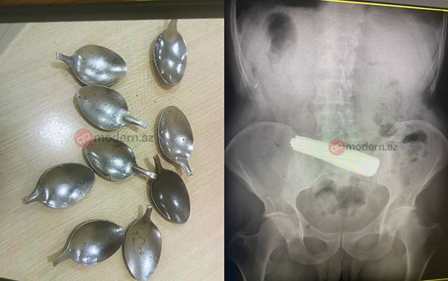 Bakı sakininin mədəsindən 9 ədəd qaşıq çıxardılıb