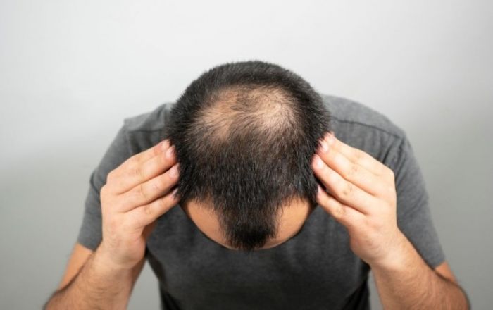 Saç tökülməsinə qarşı inqilabi kəşf