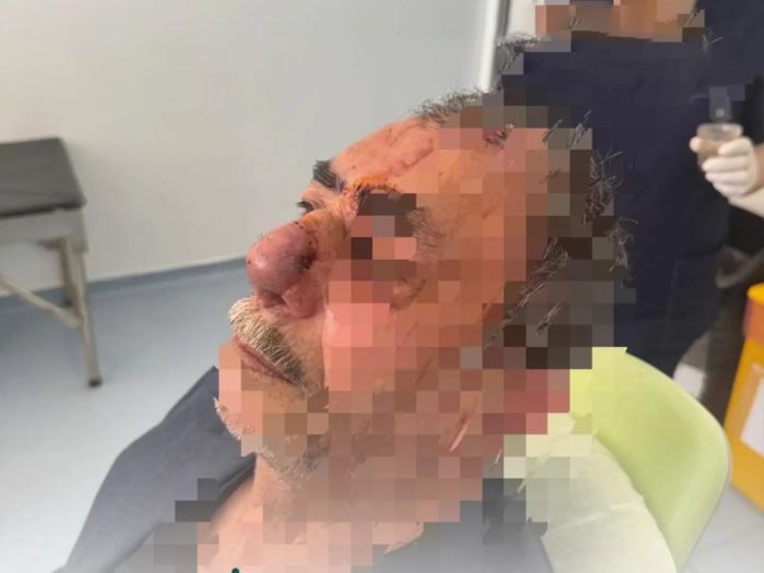 İt dişləməsi nəticəsində burnunu itirən xəstəyə yeni burun formalaşdırıldı Azərbaycanda unikal əməliyyat