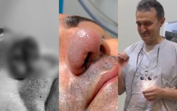 Burnunu it dişləyən xəstəyə yenisi formalaşdırıldı